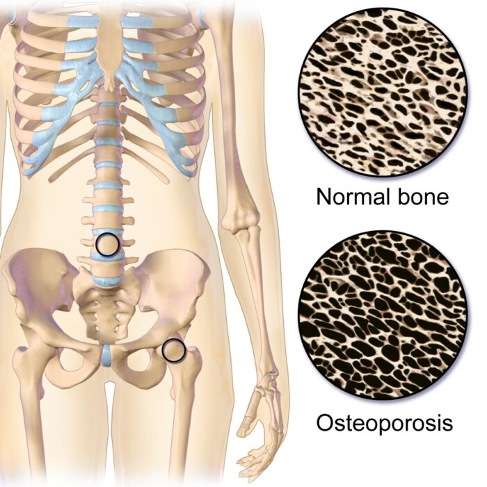 Colleferro, convegno sull'Osteoporosi: dettagli, ospiti e info