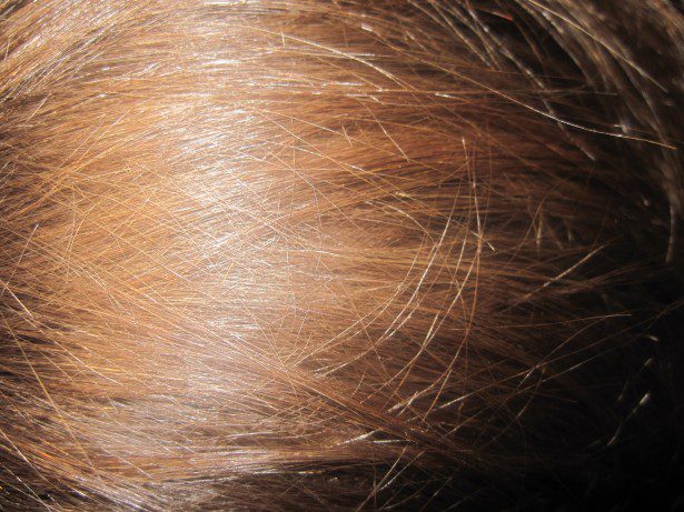 Approvata la prima pillola per l'alopecia: buone notizie per chi soffre di perdita di capelli