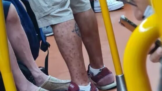 L'uomo di Monkeypox viaggia in metropolitana: la foto diventa virale. Un uomo con il vaiolo delle scimmie va in metropolitana